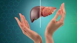 fatty liver ,Healthy Liver, Happy Life: How to Manage Fatty Liver"