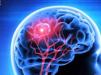 Brain Tumors 101: What You Need to Know About this Intricate Condition