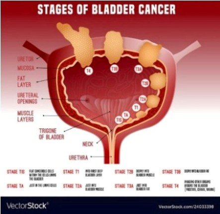Bladder Cancer Breakdown: Symptoms, Causes, and the Latest Treatments"