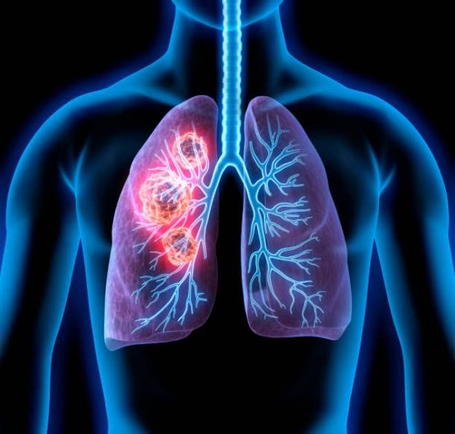 "Lung Cancer Unveiled: Lungs